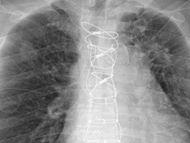 Sternum Healing & Sternal Infection Rates After Heart Surgery with Dr. Steve Bolling