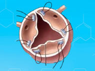 Aortic Valve Reconstruction: Patient Advantages