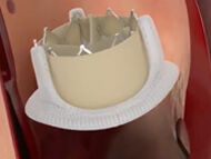 Surgeon Q&A: Heart Valve Re-Operations with Dr. Nimesh Desai