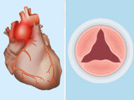 Aortic Valve Disease & Aortic Aneurysms: Surgeon Q&A with Dr. Joseph Bavaria