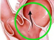 Surgeon Q&A: When Should The Mitral Valve Be Repaired?