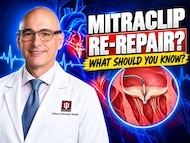 Surgeon Q&amp;A: What Happens When a MitraClip Fails?