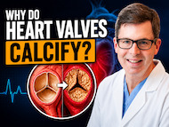 What Causes Aortic and Mitral Heart Valves to Calcify?