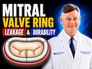 Surgeon Q&amp;A: How Long Does a Mitral Valve Repair Ring Last?